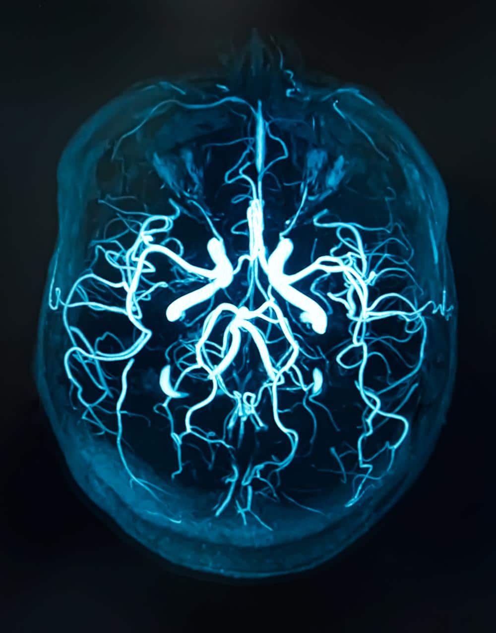 image representing a brain after a traumatic brain injury